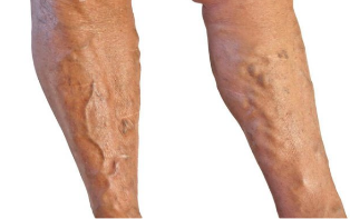 Behandlung von Krampfadern in den Beinen