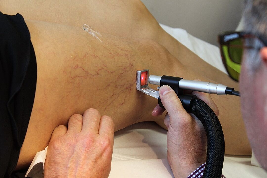 Laserkoagulation